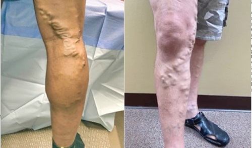 Legs showing varicose veins