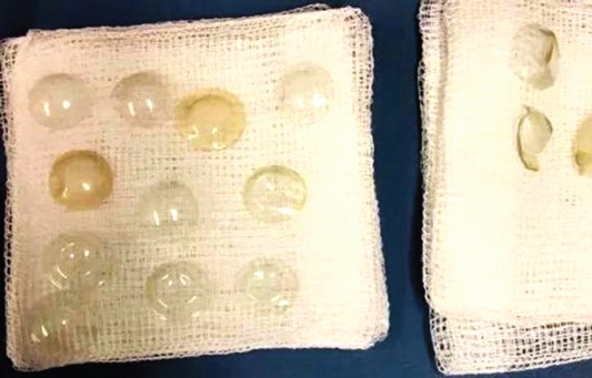 The doctors were shocked to find such number of contact lenses on one eye